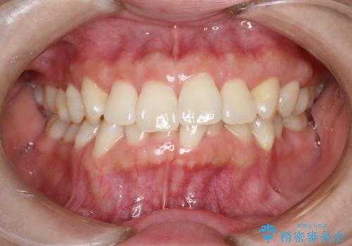 インビザライン ライトパッケージによる部分矯正治療　下の前歯のみの歯並び改善の治療前
