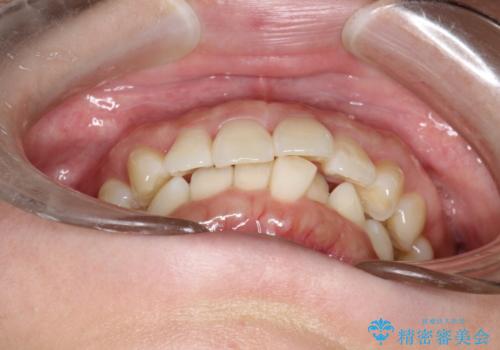 インビザライン ライトパッケージによる部分矯正治療 下の前歯のみの歯並び改善の治療前