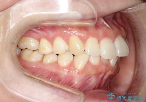 インビザライン ライトパッケージによる部分矯正治療 下の前歯のみの歯並び改善の治療前