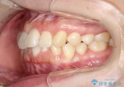 インビザライン ライトパッケージによる部分矯正治療　下の前歯のみの歯並び改善の治療前