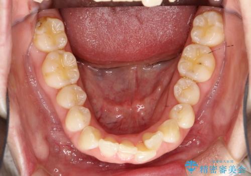 インビザライン ライトパッケージによる部分矯正治療　下の前歯のみの歯並び改善の症例 治療前