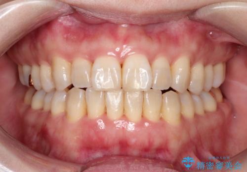 インビザラインによる矯正治療(非抜歯)　上下前歯の開き(開咬)と上下のガタつき(叢生)の改善の症例 治療後