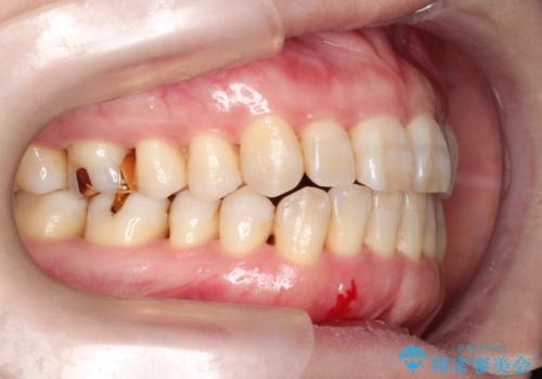 インビザラインによる矯正治療(非抜歯)　上下前歯の開き(開咬)と上下のガタつき(叢生)の改善の治療後