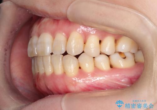 インビザラインによる矯正治療(非抜歯) 上下前歯の開き(開咬)と上下のガタつき(叢生)の改善の治療後