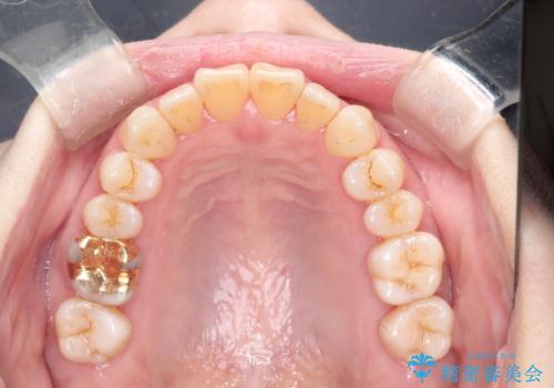 インビザラインによる矯正治療(非抜歯) 上下前歯の開き(開咬)と上下のガタつき(叢生)の改善の治療後