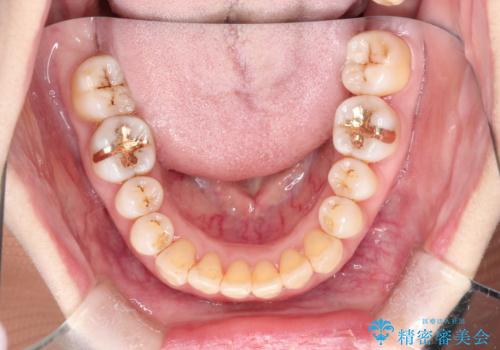 インビザラインによる矯正治療(非抜歯) 上下前歯の開き(開咬)と上下のガタつき(叢生)の改善の治療後