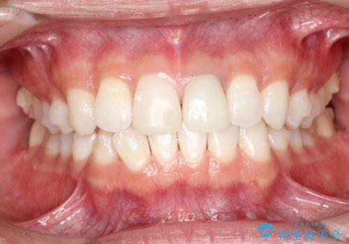 インビザラインによる矯正治療(非抜歯)　下の前歯の歯並びの改善の治療中