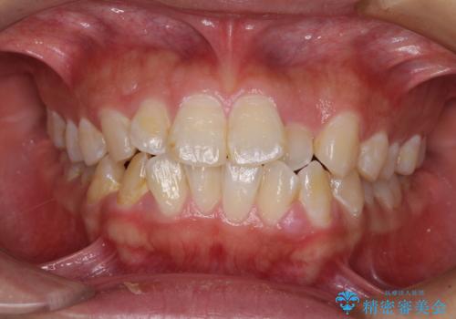 口が閉じにくい　ワイヤー装置での抜歯矯正の症例 治療前