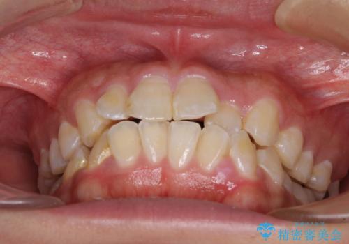 口が閉じにくい ワイヤー装置での抜歯矯正の治療前