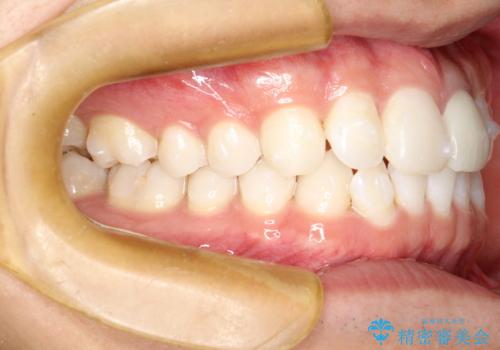 インビザラインによる矯正治療(非抜歯) 下の前歯の歯並びの改善の治療中