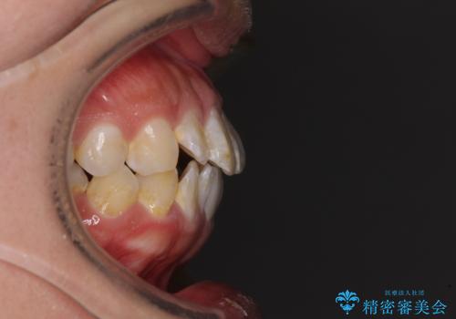 口が閉じにくい ワイヤー装置での抜歯矯正の治療前