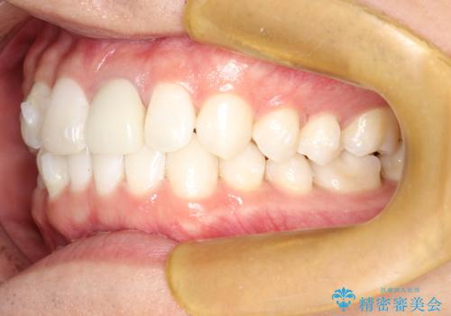 インビザラインによる矯正治療(非抜歯)　下の前歯の歯並びの改善の治療中