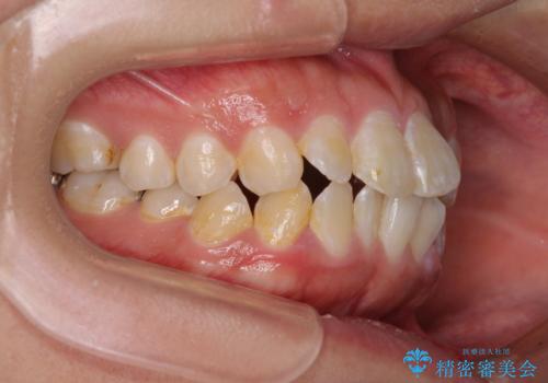 口が閉じにくい ワイヤー装置での抜歯矯正の治療前