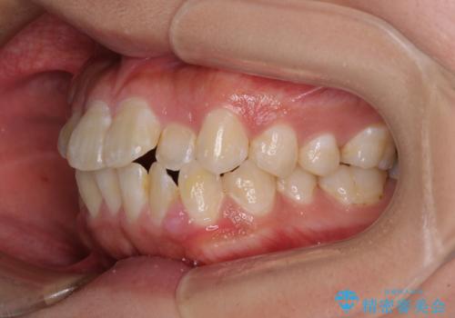 口が閉じにくい ワイヤー装置での抜歯矯正の治療前