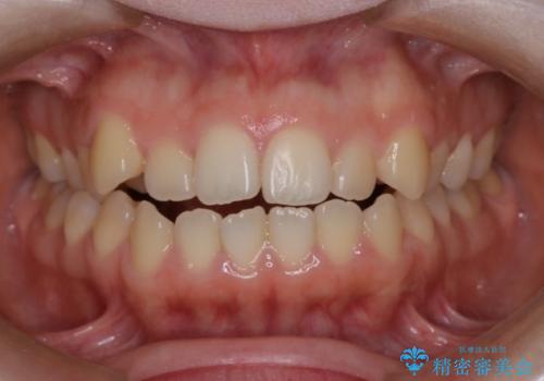 前歯のガタツキ、前歯の噛み合わせ(開咬)をインビザライン治療で治しましたの症例 治療前