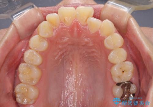 口が閉じにくい ワイヤー装置での抜歯矯正の治療前