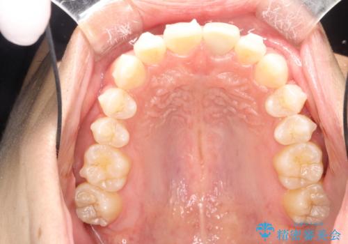 インビザラインによる矯正治療(非抜歯) 下の前歯の歯並びの改善の治療中