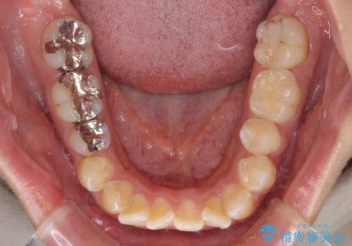 口が閉じにくい ワイヤー装置での抜歯矯正の治療前