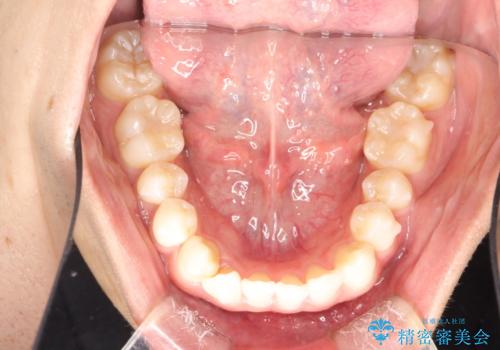 インビザラインによる矯正治療(非抜歯) 下の前歯の歯並びの改善の治療中