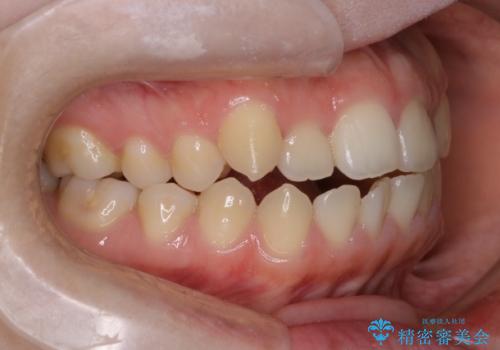 前歯のガタツキ、前歯の噛み合わせ(開咬)をインビザライン治療で治しましたの治療前