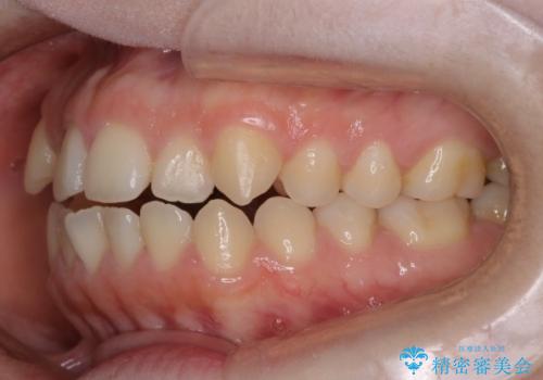 前歯のガタツキ、前歯の噛み合わせ(開咬)をインビザライン治療で治しましたの治療前