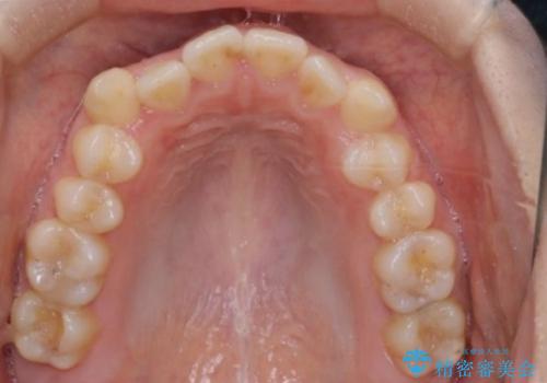 前歯のガタツキ、前歯の噛み合わせ(開咬)をインビザライン治療で治しましたの治療前