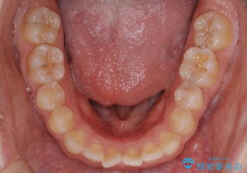 前歯のガタツキ、前歯の噛み合わせ(開咬)をインビザライン治療で治しましたの治療前