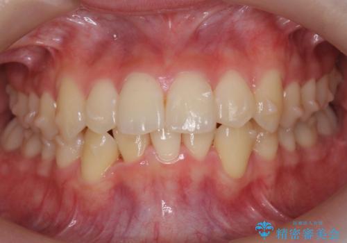 他3軒で4本抜いてワイヤー矯正と言われた 1本の抜歯でマウスピース矯正で治療可能ですの治療中