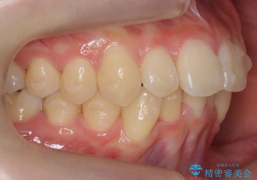 他3軒で4本抜いてワイヤー矯正と言われた 1本の抜歯でマウスピース矯正で治療可能ですの治療中