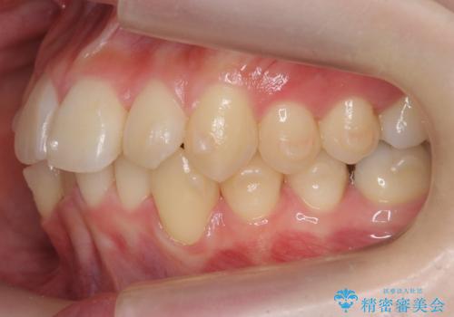 他3軒で4本抜いてワイヤー矯正と言われた 1本の抜歯でマウスピース矯正で治療可能ですの治療中