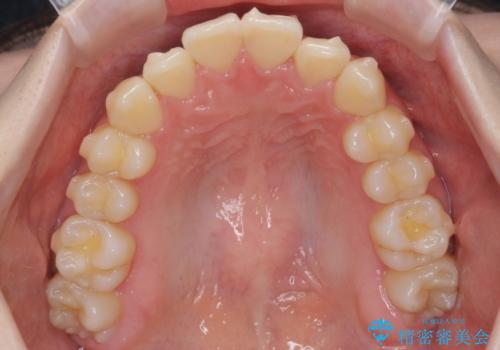 他3軒で4本抜いてワイヤー矯正と言われた 1本の抜歯でマウスピース矯正で治療可能ですの治療中
