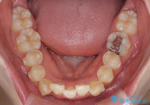 他3軒で4本抜いてワイヤー矯正と言われた 1本の抜歯でマウスピース矯正で治療可能ですの治療中
