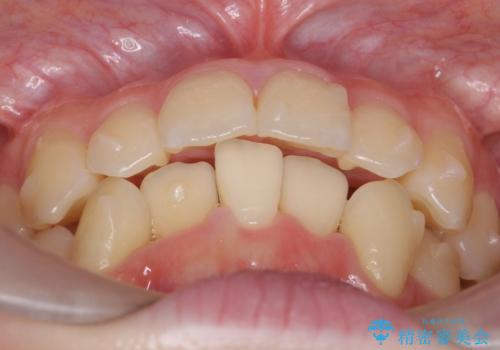 他3軒で4本抜いてワイヤー矯正と言われた 1本の抜歯でマウスピース矯正で治療可能ですの治療中