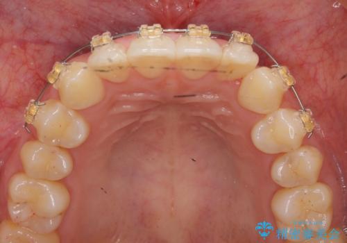 ワイヤー部分矯正治療を併用したマウスピース矯正治療の治療中