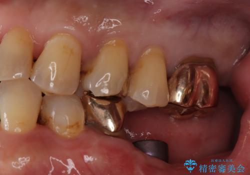 【ゴールドインレー PGA】フロスをしたら銀歯が取れたの治療後