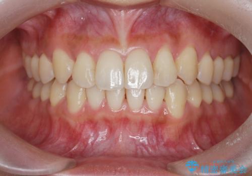 ワイヤー部分矯正治療を併用したマウスピース矯正治療の症例 治療後