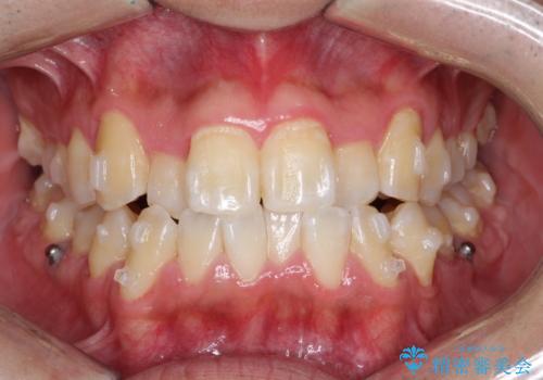 マウスピース矯正で素敵な笑顔に変身!前歯のガタツキを治しましたの治療中
