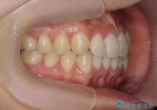 ワイヤー部分矯正治療を併用したマウスピース矯正治療の治療後