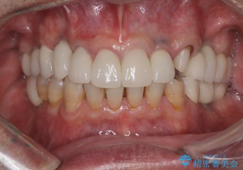 【オールセラミッククラウン・ファイバーコア】被せ物が揺れているの治療中