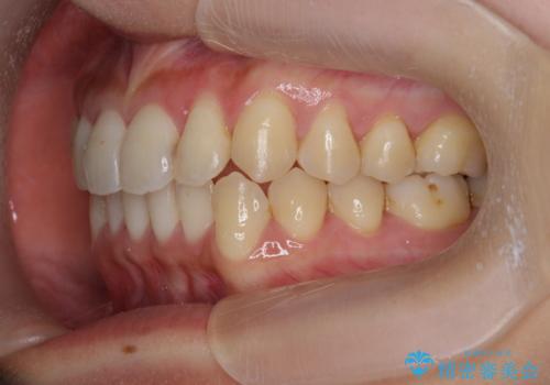 ワイヤー部分矯正治療を併用したマウスピース矯正治療の治療後