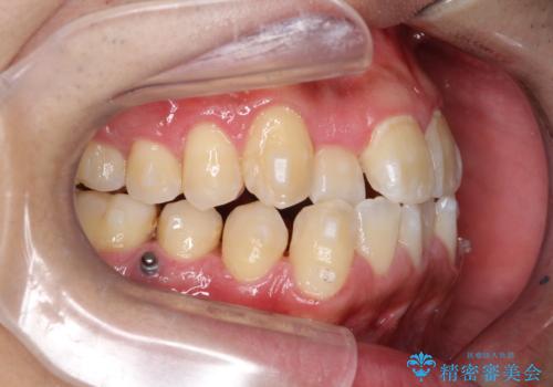 マウスピース矯正で素敵な笑顔に変身!前歯のガタツキを治しましたの治療中
