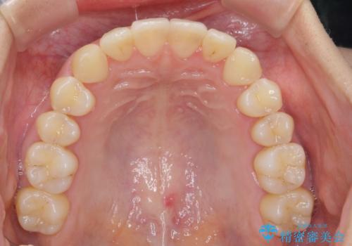 ワイヤー部分矯正治療を併用したマウスピース矯正治療の治療後