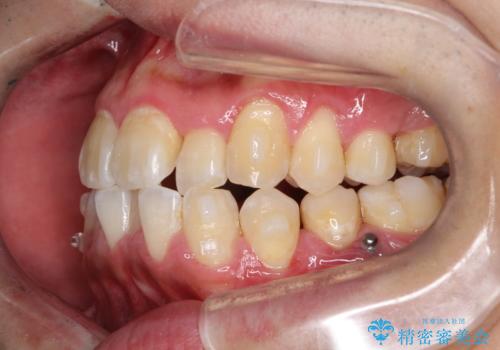 マウスピース矯正で素敵な笑顔に変身!前歯のガタツキを治しましたの治療中