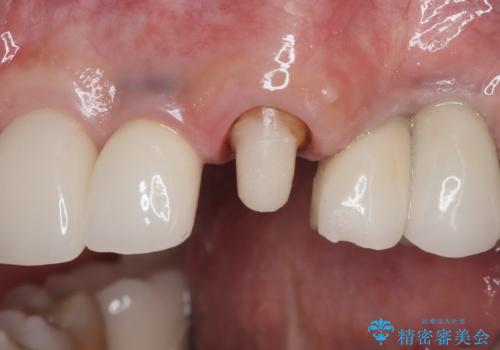 【オールセラミッククラウン・ファイバーコア】被せ物が揺れているの治療中