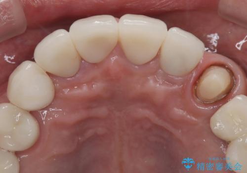 【オールセラミッククラウン・ファイバーコア】被せ物が揺れているの治療中