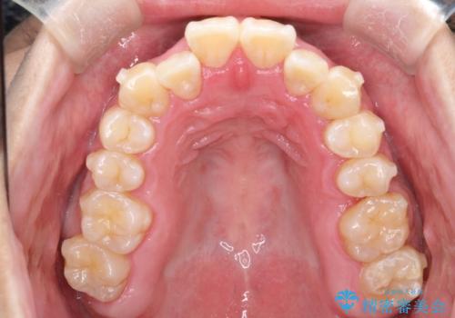 マウスピース矯正で素敵な笑顔に変身!前歯のガタツキを治しましたの治療中