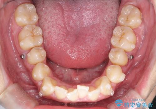 マウスピース矯正で素敵な笑顔に変身!前歯のガタツキを治しましたの治療中