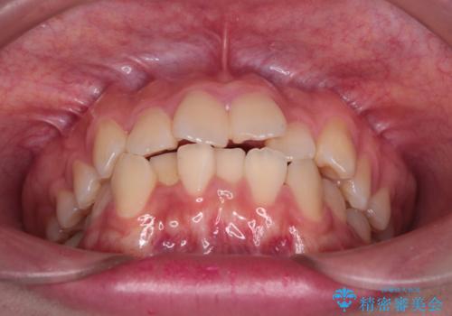 【審美装置】前歯のがたがたを治したい。の治療前
