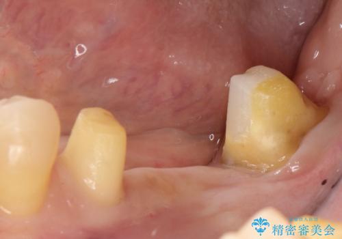 部分矯正してからオールセラミックブリッジの治療中