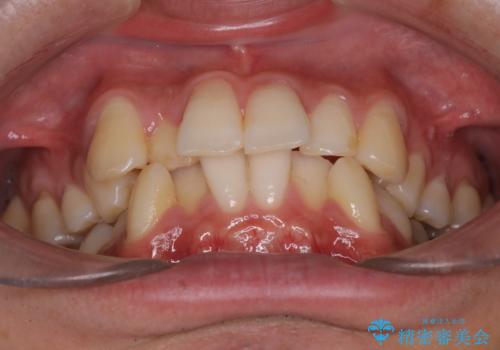 【インビザライン】マウスピース矯正希望。の治療前